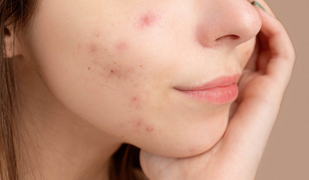 A close-up image showing a section of a face with visible acne blemishes.
